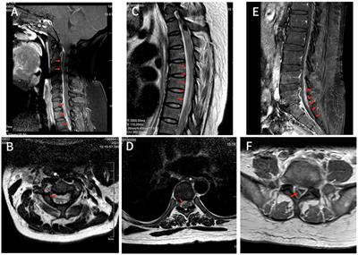 Extensive spinal epidural abscess due to Streptococcus intermedius: a case report treated conservatively and literature review